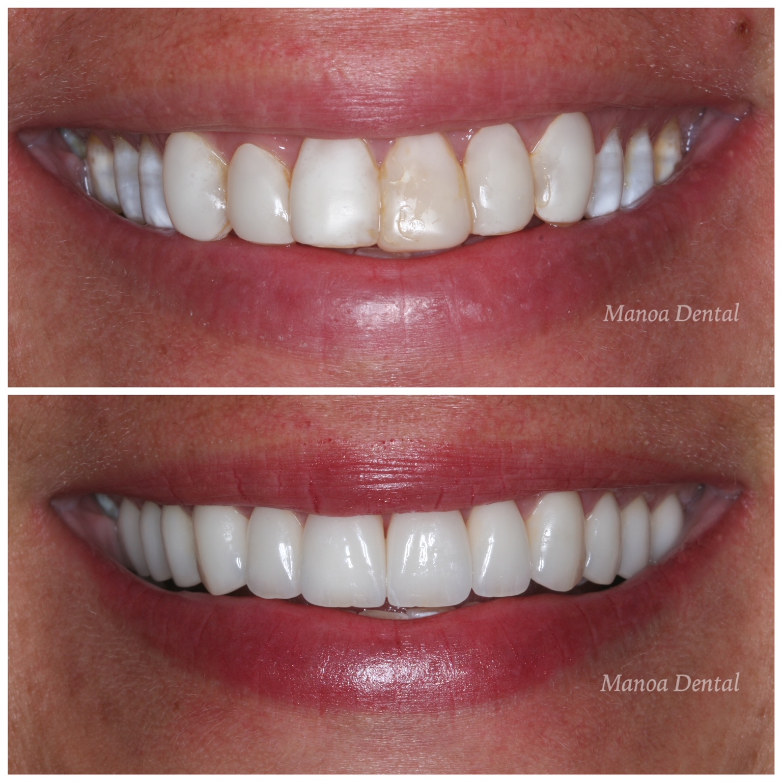 Porcelain Veneers Oahu Hawaii Honolulu Best Cosmetic Dentist Oahu